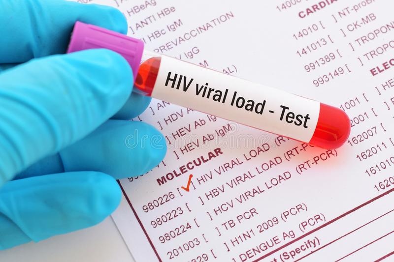 blood sample hiv viral load test hiv viral load test 101048096